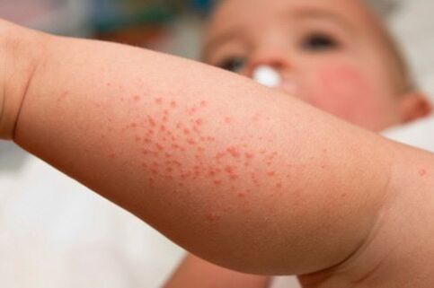 Alergia en un niño como síntoma de la presencia de gusanos.