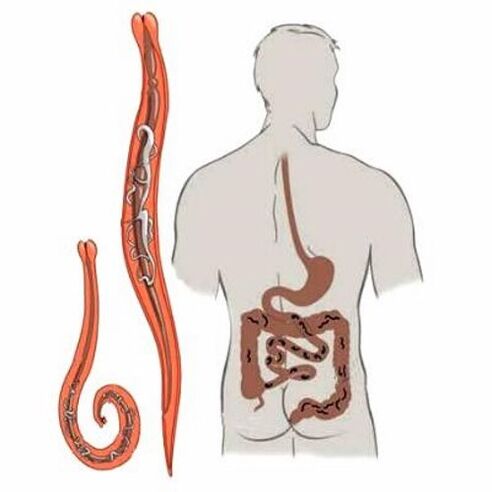 Gusanos en el intestino humano.